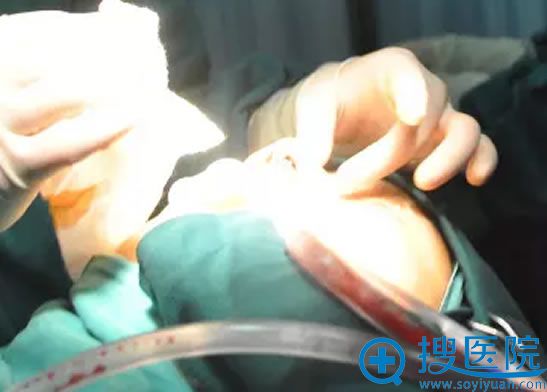 肋软骨隆鼻手术之放置软骨图片 肋软骨隆鼻手术之放置软骨图片