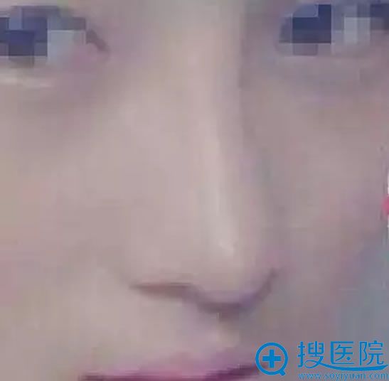肋软骨隆鼻手术效果图 肋软骨隆鼻手术效果图