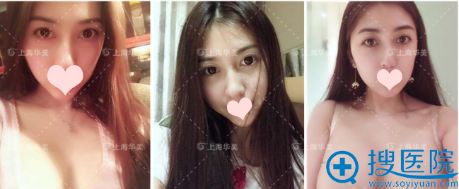 特贝茨隆胸术后7天的样子 特贝茨隆胸术后7天的样子