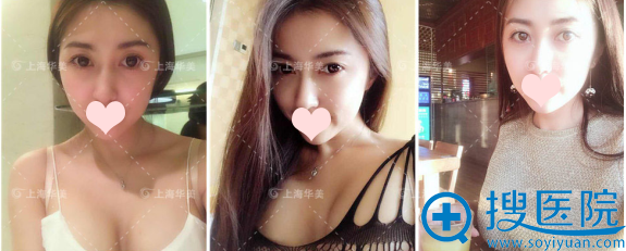 在华美做完假体隆胸13天了 在华美做完假体隆胸13天了