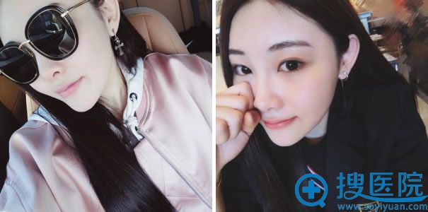 在北京做线雕隆鼻一个月效果 在北京做线雕隆鼻一个月效果