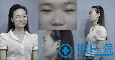 双眼皮术隆鼻瘦脸术前照片 双眼皮术隆鼻瘦脸术前照片