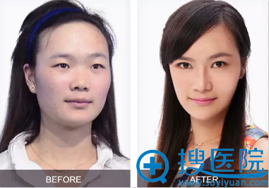 宁波美莱双眼皮隆鼻瘦脸术后对比照片 宁波美莱双眼皮隆鼻瘦脸术后对比照片