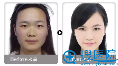 宁波美莱瘦脸术后对比效果 宁波美莱瘦脸术后对比效果