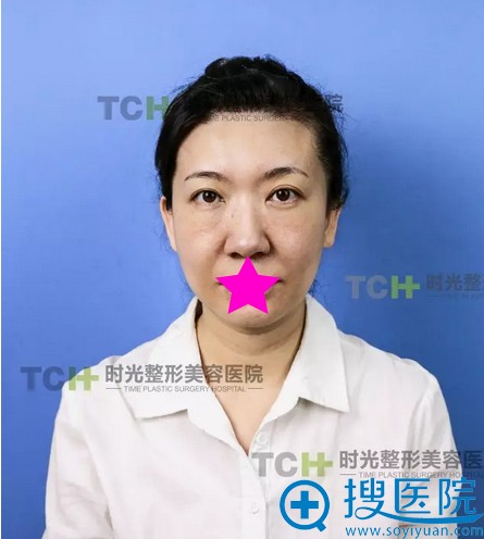 杭州时光青春扣面部埋线提升案例 霸道女总裁秒变小萝莉