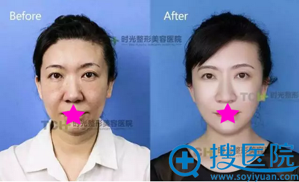 青春扣埋线提升治疗术后对比效果 青春扣埋线提升治疗术后对比效果