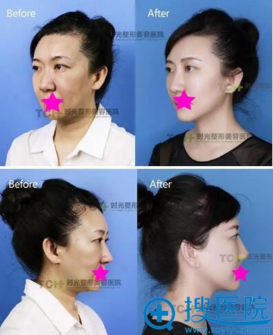 杭州时光埋线提升术后侧脸对比图 杭州时光埋线提升术后侧脸对比图