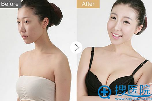 武汉艺星自体脂肪隆胸前后对比照 武汉艺星自体脂肪隆胸前后对比照