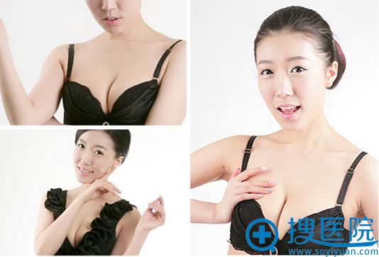 自体脂肪隆胸效果图 自体脂肪隆胸效果图
