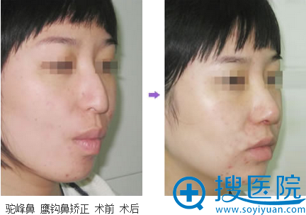 沈阳名流整形美容医院驼峰鼻矫正术后对比效果 沈阳名流整形美容医院驼峰鼻矫正术后对比效果