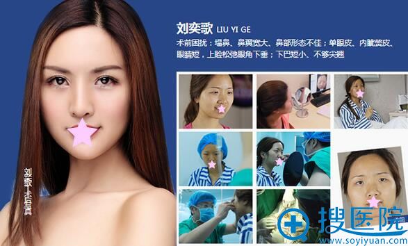 沈阳美莱整形美容医院双眼皮隆鼻隆下巴案例 沈阳美莱整形美容医院双眼皮隆鼻隆下巴案例