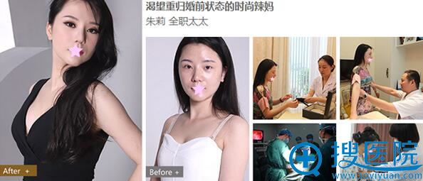 沈阳美莱整形美容医院假体丰胸案例 沈阳美莱整形美容医院假体丰胸案例