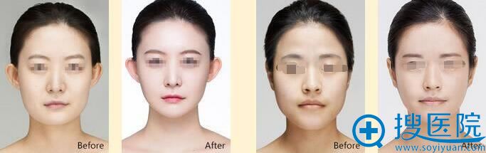 沈阳美莱整形美容医院案例 沈阳美莱整形美容医院案例