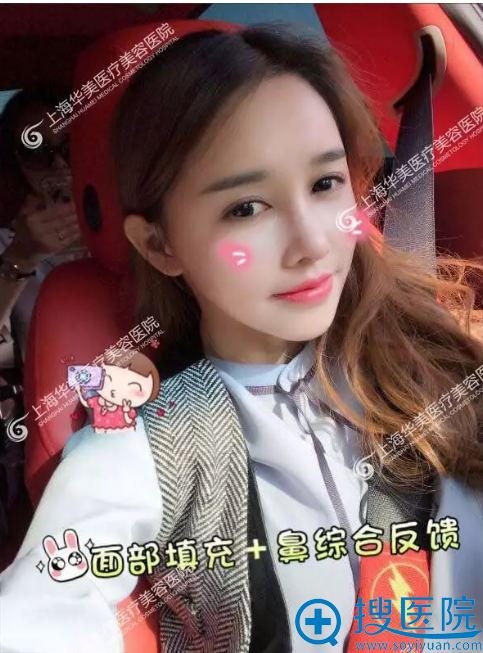 看看我找上海华美李健做完脂肪填充和鼻综合隆鼻后变化有多大