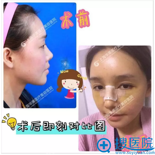 面部脂肪填充+鼻综合前后对比图 面部脂肪填充+鼻综合前后对比图