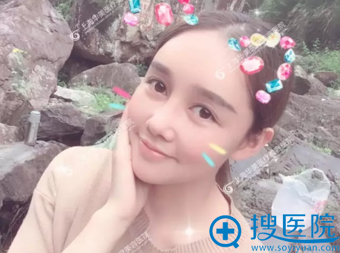 脂肪填充术后两周生活照 脂肪填充术后两周生活照