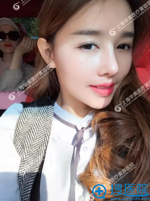 鼻综合术后3周自拍 鼻综合术后3周自拍
