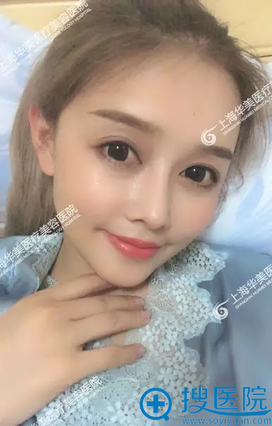 脂肪填充+鼻综合术后两个月效果 脂肪填充+鼻综合术后两个月效果