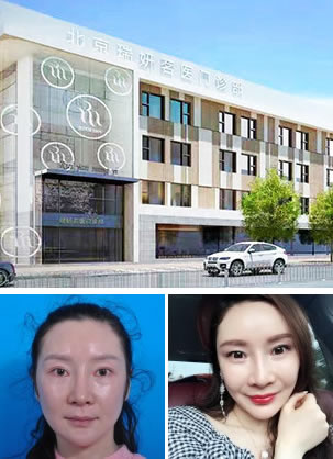 北京瑞妍茗医做自体脂肪全脸填充效果怎么样?鲁树荣案例展示
