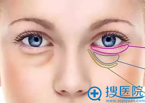 眼袋 眼袋