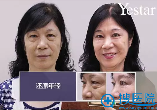 去眼袋哪里做?来温州艺星看大妈外切祛眼袋后的惊人效果
