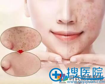 脸上长斑怎么办? 脸上长斑怎么办?