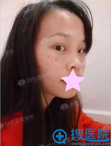 蜂巢皮秒激光祛色斑术前照片 蜂巢皮秒激光祛色斑术前照片