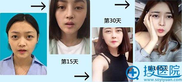 北京京通李茵双眼皮修复案例图 北京京通李茵双眼皮修复案例图