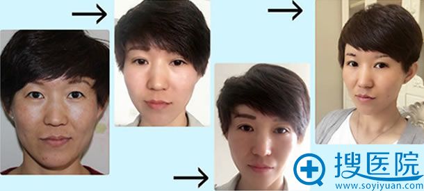 北京京通李茵全切双眼皮案例 北京京通李茵全切双眼皮案例