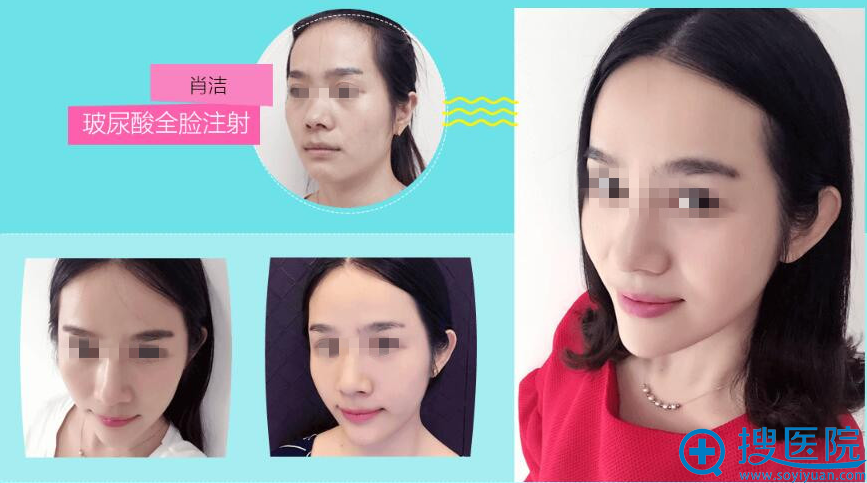 玻尿酸注射 玻尿酸注射