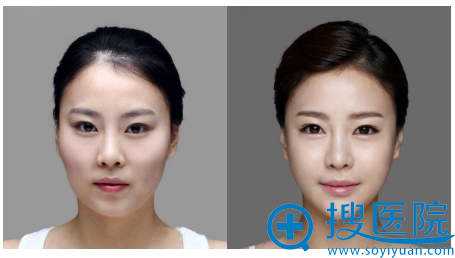 上海华美李志海改脸型案例 上海华美李志海改脸型案例