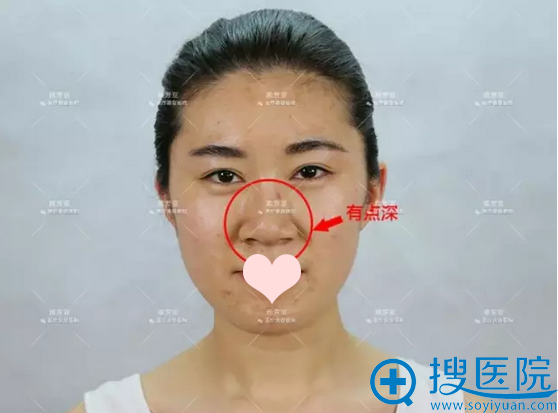 隆鼻术前照 隆鼻术前照