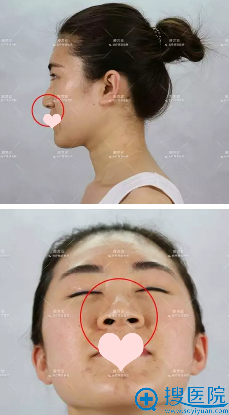 隆鼻术前照 隆鼻术前照