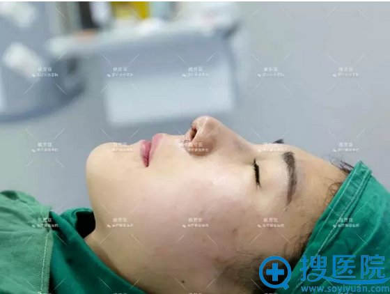 鼻综合术后即刻效果 鼻综合术后即刻效果