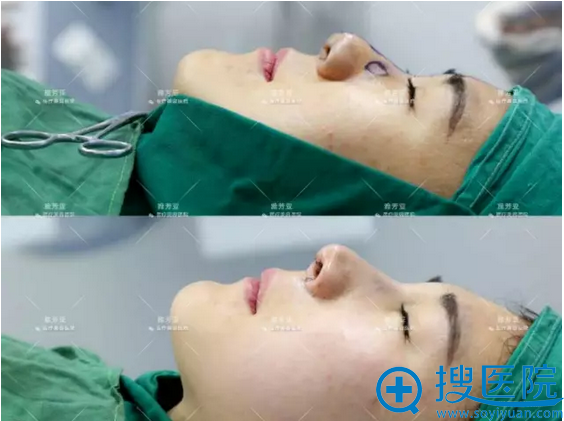 鼻综合前后特写对比 鼻综合前后特写对比
