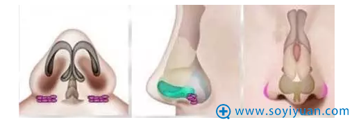 鼻基底抬高3d演示图 鼻基底抬高3d演示图