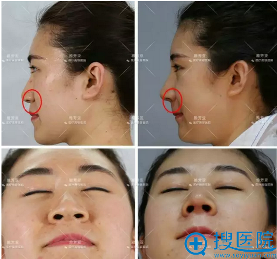 石家庄雅芳亚鼻综合术后一周对比图 石家庄雅芳亚鼻综合术后一周对比图