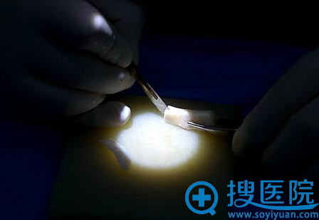 肋软骨进行细心雕刻 肋软骨进行细心雕刻