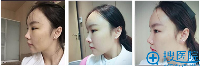 手术后15天 手术后15天