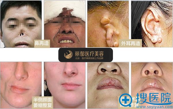 北京丽都吴玉家五官修复案例 北京丽都吴玉家五官修复案例