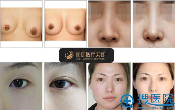 北京丽都吴玉家整形失败修复案例 北京丽都吴玉家整形失败修复案例