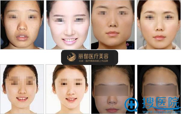 北京丽都吴玉家面部综合整形案例 北京丽都吴玉家面部综合整形案例