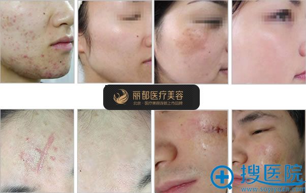 北京丽都吴玉家瘢痕修复案例 北京丽都吴玉家瘢痕修复案例