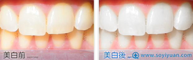 冷光美白牙前后对比照片 冷光美白牙前后对比照片