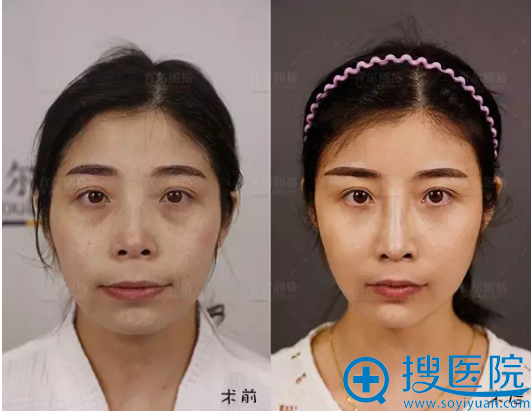 【真人秀】上海首尔丽格隆鼻+下颏截骨前移+全面部脂肪填充案例