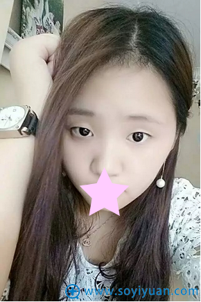 朱武根双眼皮术前照片 朱武根双眼皮术前照片