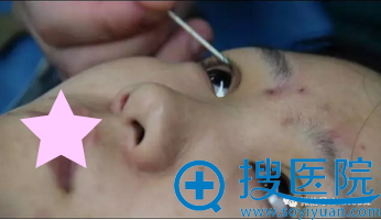 朱武根双眼皮手术进行中 朱武根双眼皮手术进行中