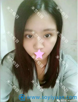 深圳米兰柏羽双眼皮术后7天恢复效果 深圳米兰柏羽双眼皮术后7天恢复效果