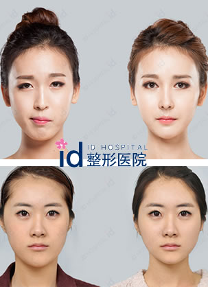 韩国双鄂手术大概多少钱?ID整形10万打造美丽脸型案例图