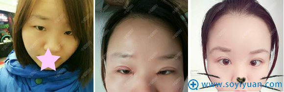 <!--<i data=20240710 data-id=12374></i>-->整形美容医院全切双眼皮案例 <!--<i data=20240710 data-id=12374></i>-->整形美容医院全切双眼皮案例